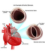An Example of Aortic Stenosis 
