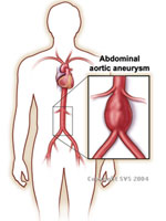 surgical aneurysm repair