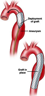 endovascular stent grafting
