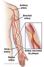arm artery disease
